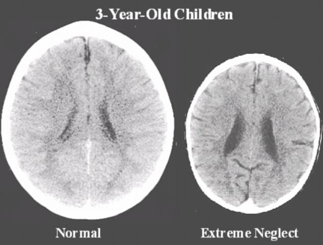 Brain scans of 3-year old children: normal vs neglected